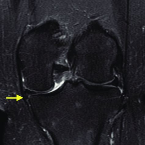 The Trapped Medial Meniscus Tear 